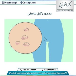 درمان زگیل تناسلی